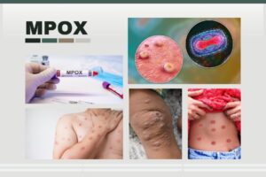 Mpox virus illustration