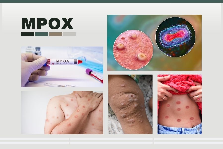 Mpox virus illustration